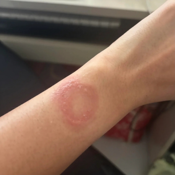 Власник Apple Watch поскаржився на опік зап'ястя: Apple не реагує на скаргу