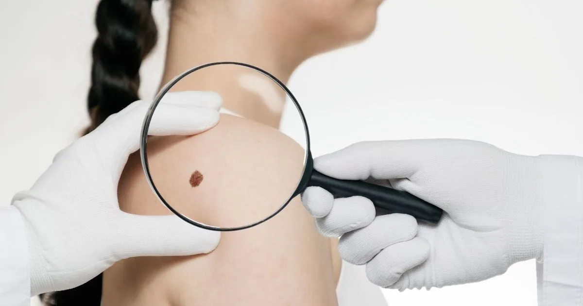 Як розпізнати меланому: ознаки, які потрібно знати кожній людині